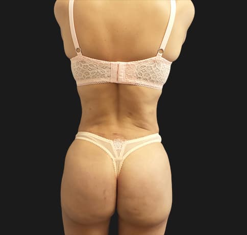 Case 41811, Performed By Dr. Tehrani – After