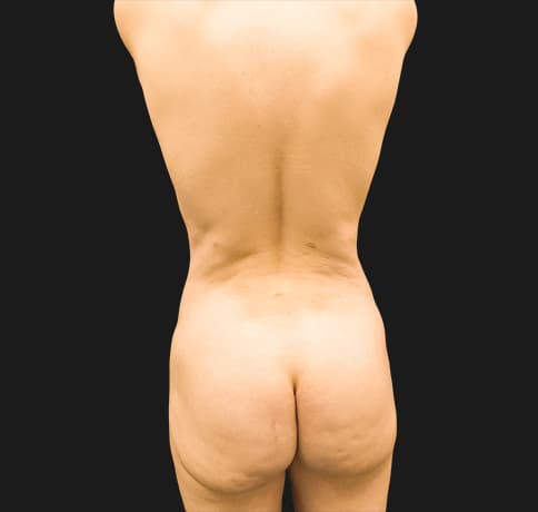 Case 41811, Performed By Dr. Tehrani – Before