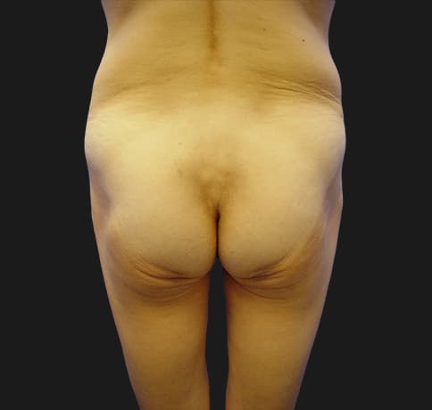 Case 6896, Performed By Dr. Tehrani – Before