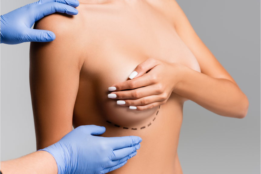 breast augmentation