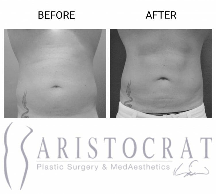 43 Times Liposuction Transformed Our Patients (Before and After