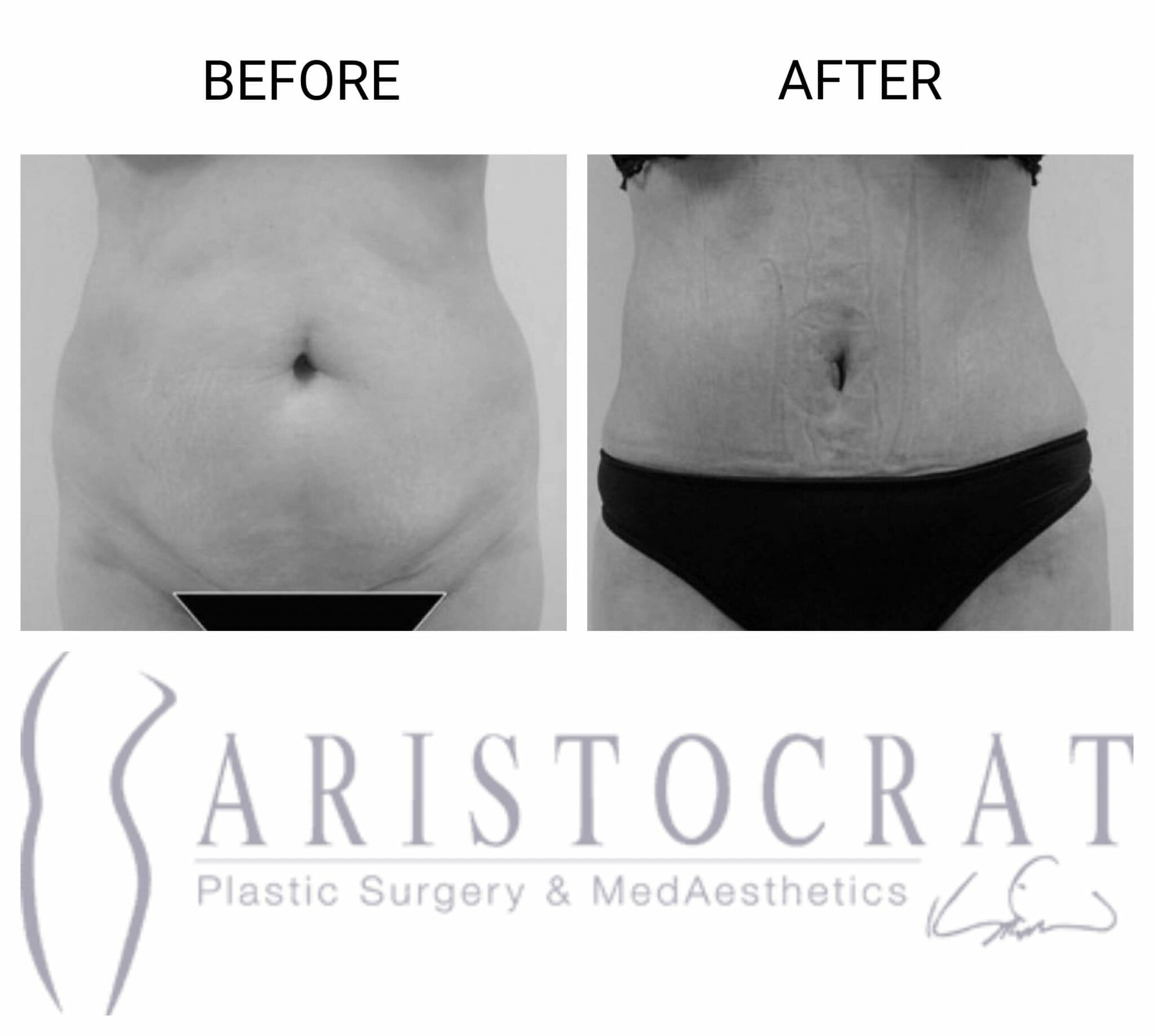 Abdomen and Waist Liposuction - Before and After Photos