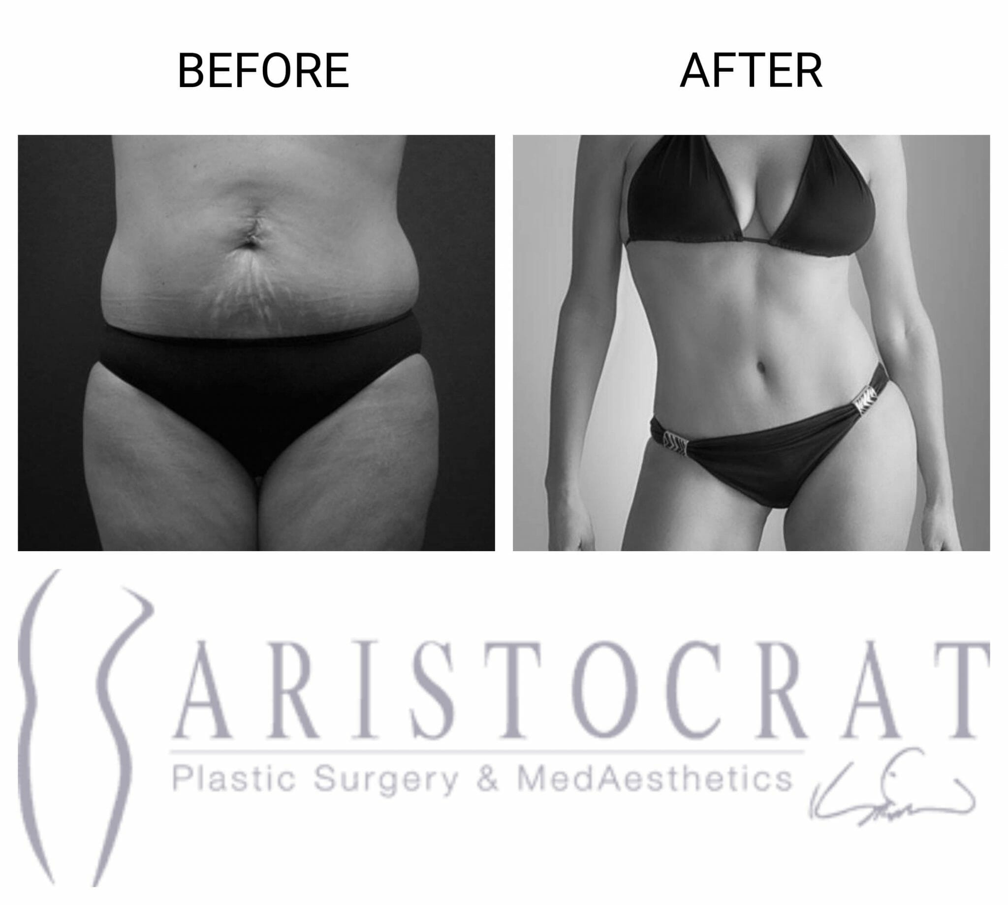 Liposuction - Inner and/or Outer Thighs Before and After Photo
