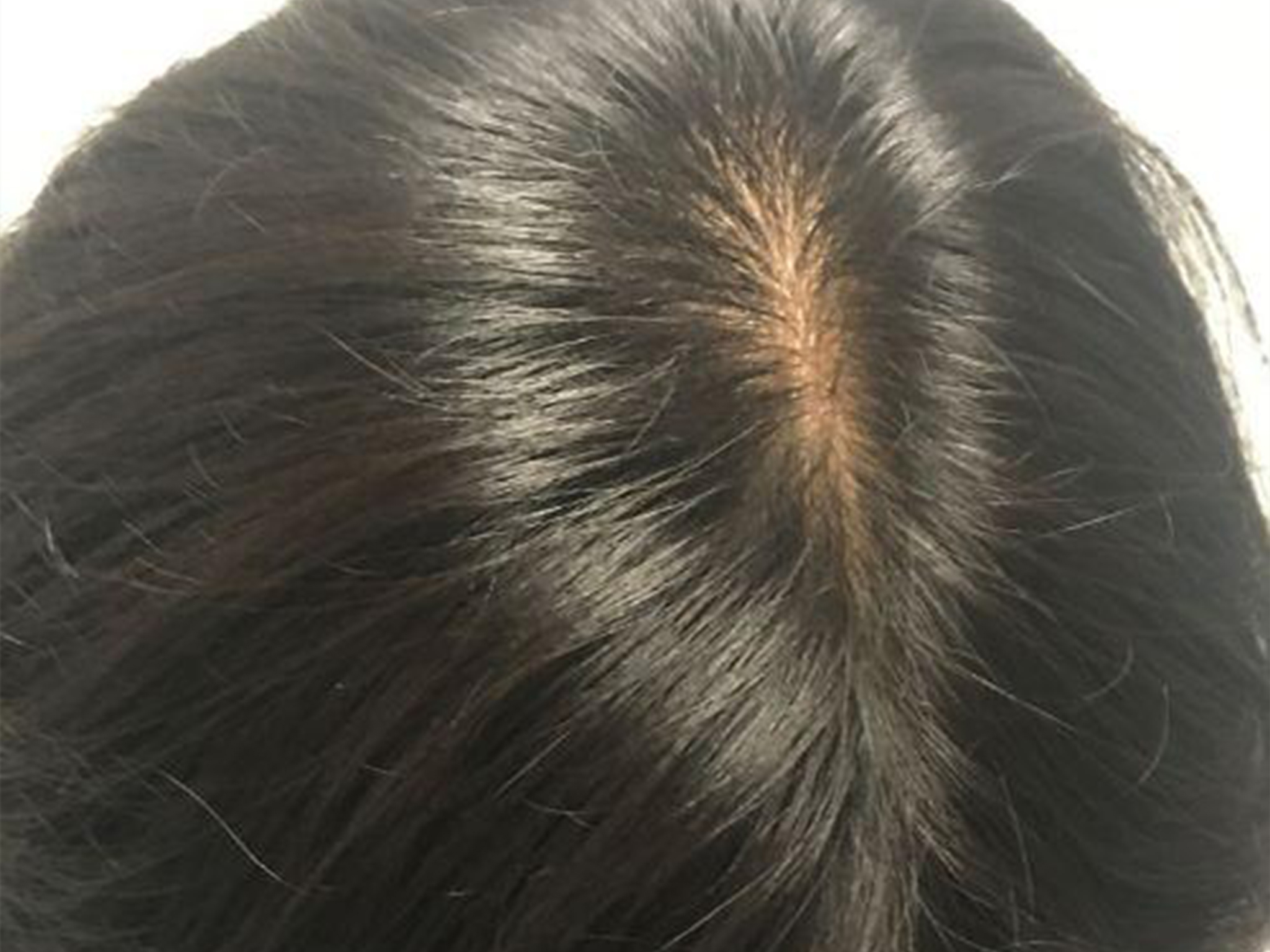 hair-regeneration-new-york-case1-after1-08-16-2018-06-35-53