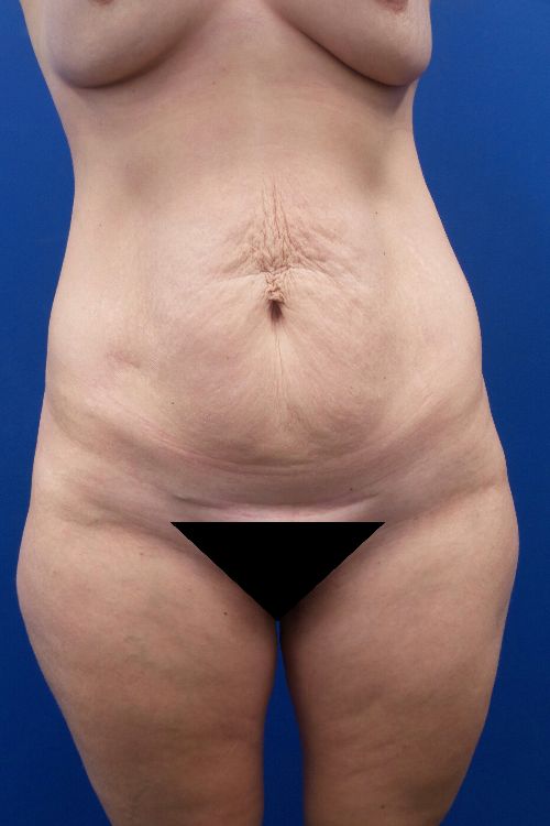 Aerolase - A 15 year old tummy tuck scar that has haunted this patient is  now almost cleared in only 4 Aerolase Neo Elite® sessions at Northeastern  Plastic Surgery office (performed by